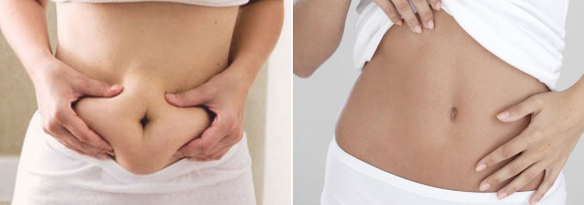 abdominoplastie